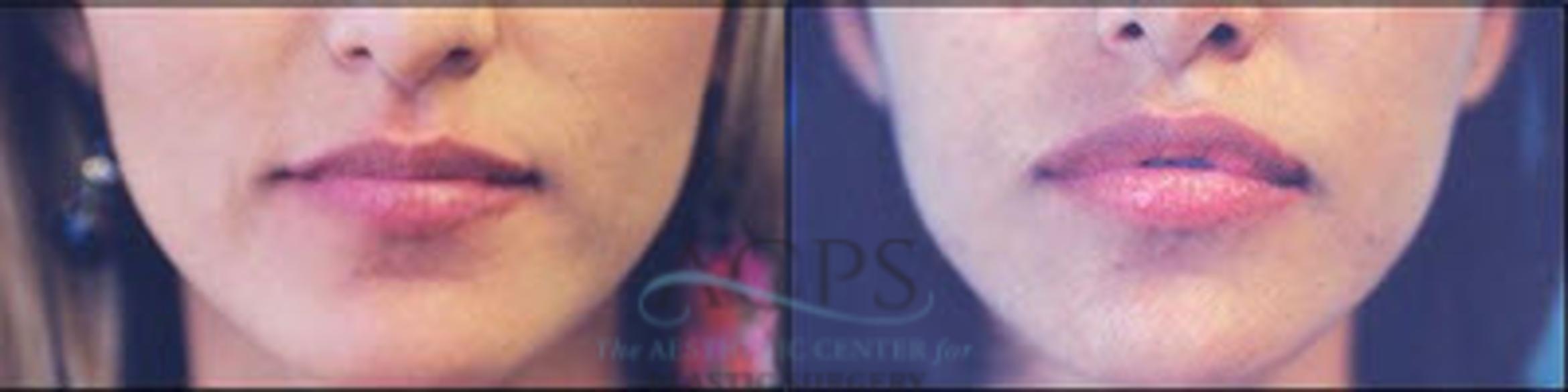 Before & After Fat Grafting Case 1349 Front View: View in Houston, TX