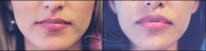 Before & After Fat Grafting Case 1349 Front View: View in Houston, TX