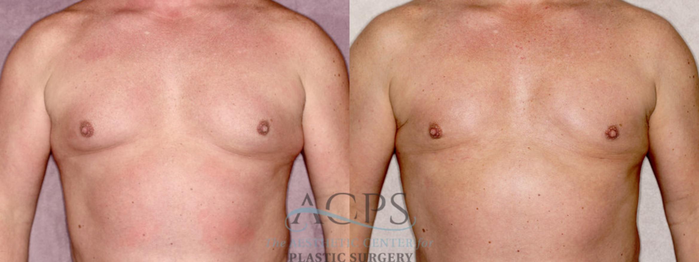 Before & After Gynecomastia Case 1409 Front View: View in Houston, TX