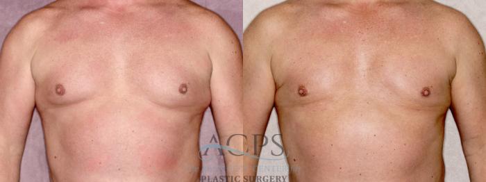 Before & After Gynecomastia Case 1409 Front View: View in Houston, TX