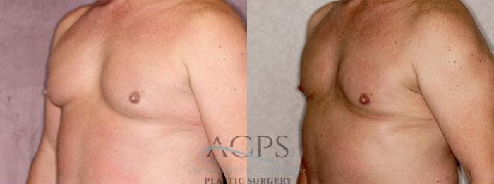 Before & After Gynecomastia Case 1409 Oblique Left View: View in Houston, TX
