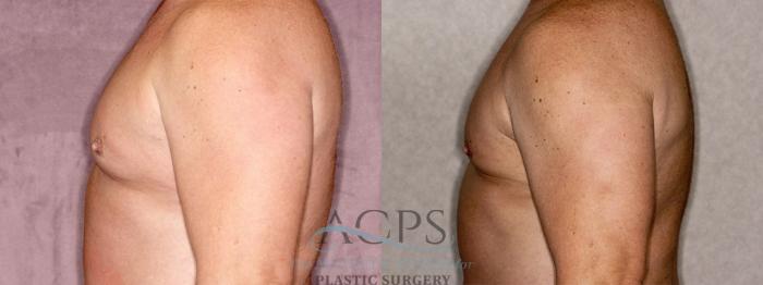 Before & After Gynecomastia Case 1409 Side Left View: View in Houston, TX