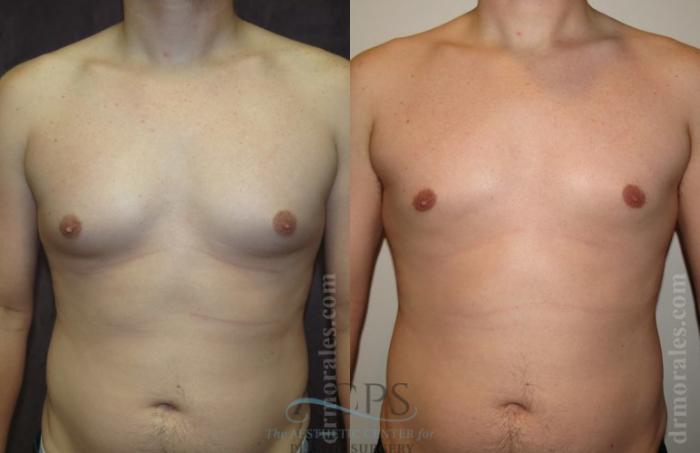 Before & After Gynecomastia Case 1420 Front View: View in Houston, TX