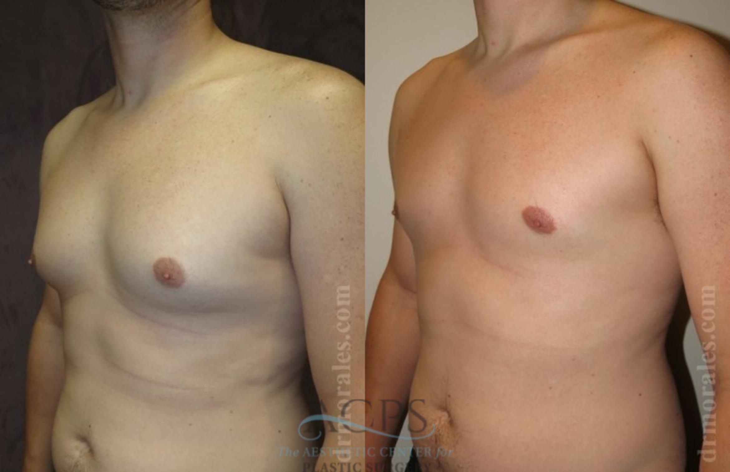Before & After Gynecomastia Case 1420 Oblique View: View in Houston, TX