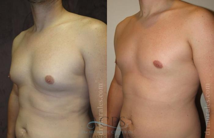 Before & After Gynecomastia Case 1420 Oblique View: View in Houston, TX