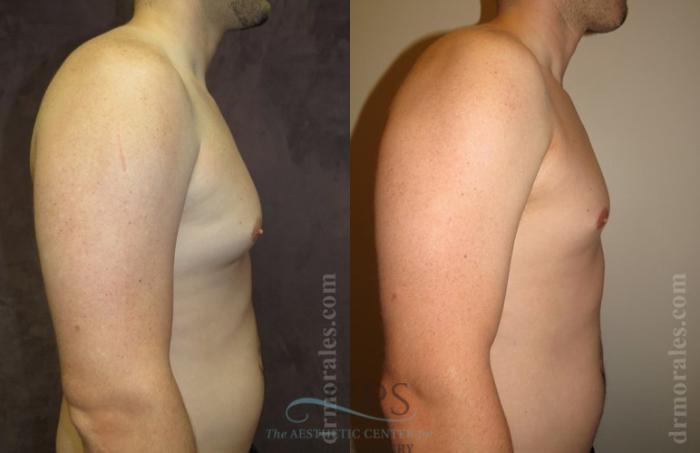 Before & After Gynecomastia Case 1420 Side View: View in Houston, TX
