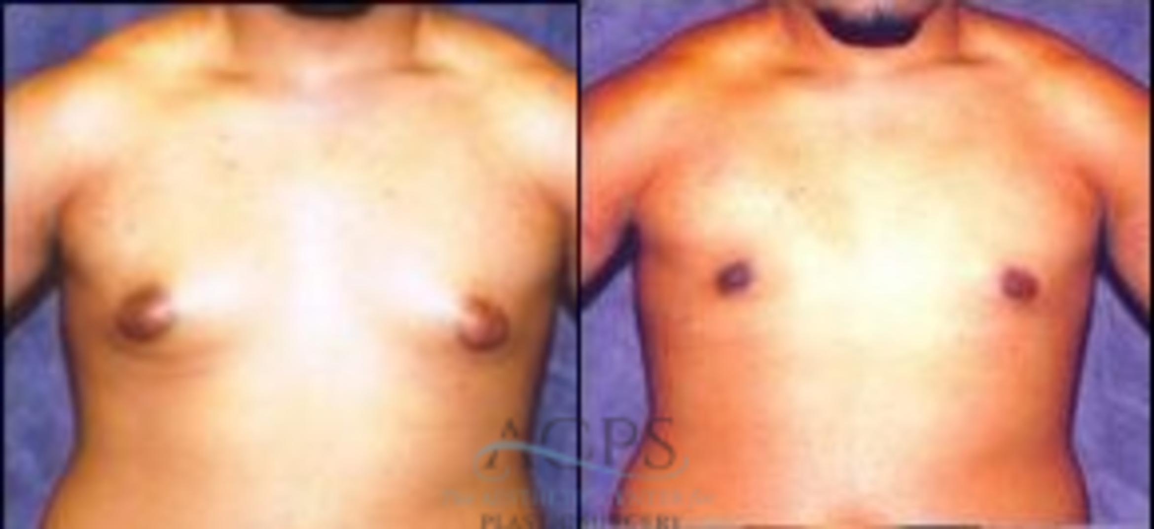 Before & After Gynecomastia Case 1421 Front View: View in Houston, TX