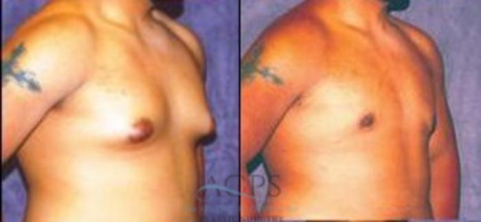 Before & After Gynecomastia Case 1421 Oblique View: View in Houston, TX