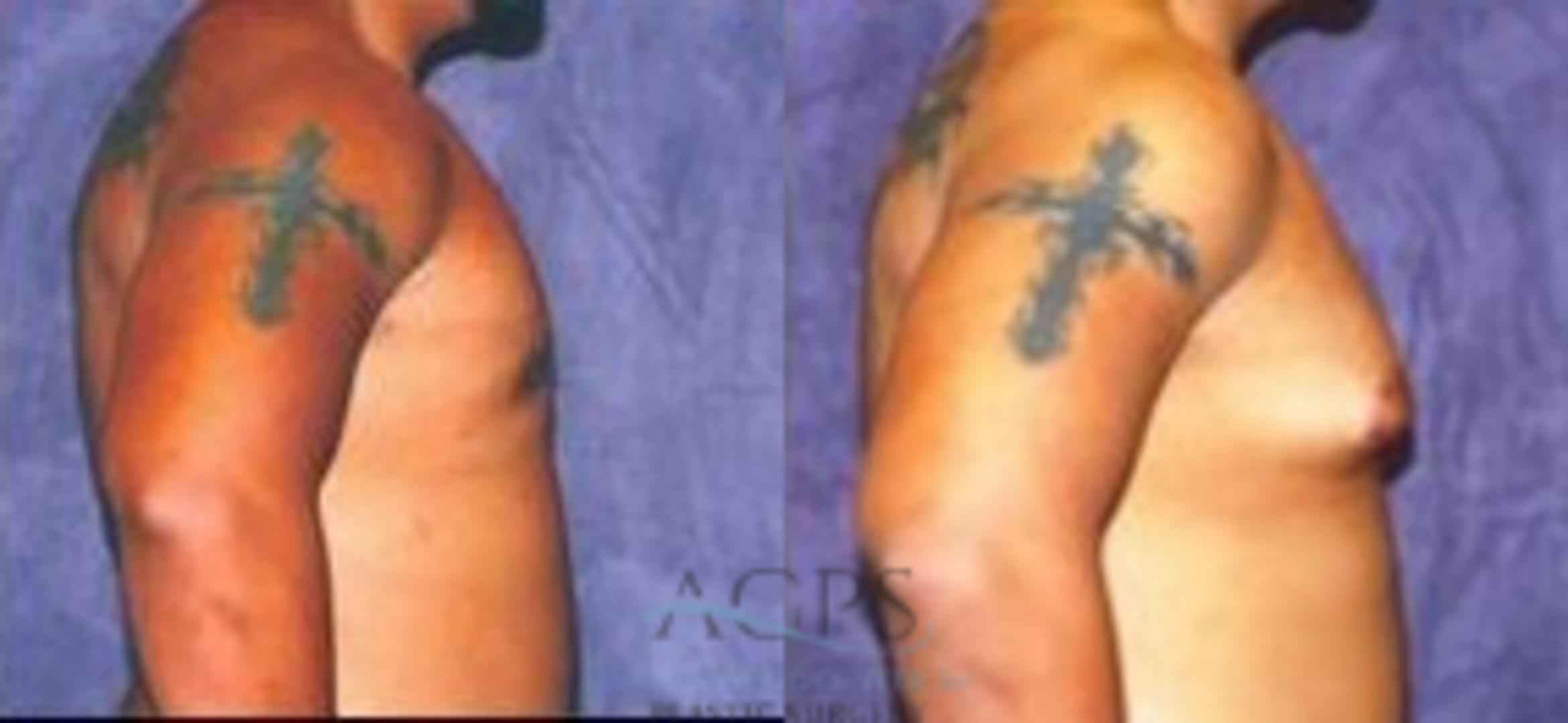 Before & After Gynecomastia Case 1421 Side View: View in Houston, TX