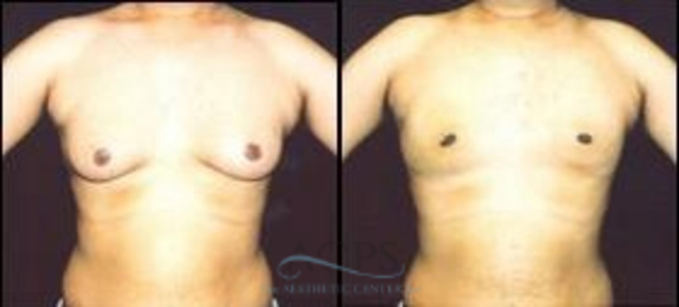 Before & After Gynecomastia Case 1422 Front View: View in Houston, TX