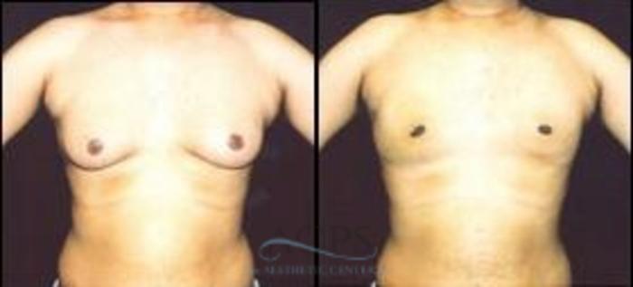 Before & After Gynecomastia Case 1422 Front View: View in Houston, TX