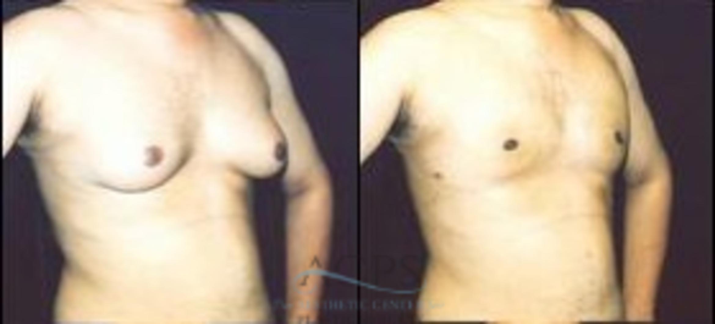 Before & After Gynecomastia Case 1422 Oblique View: View in Houston, TX