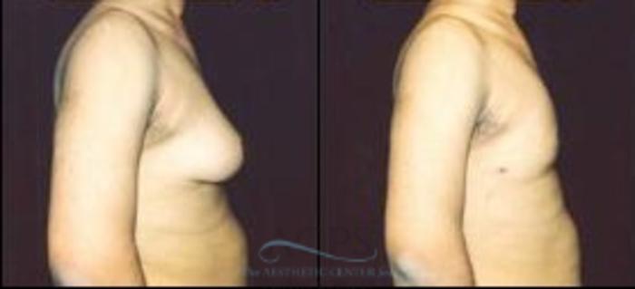 Before & After Gynecomastia Case 1422 Side View: View in Houston, TX