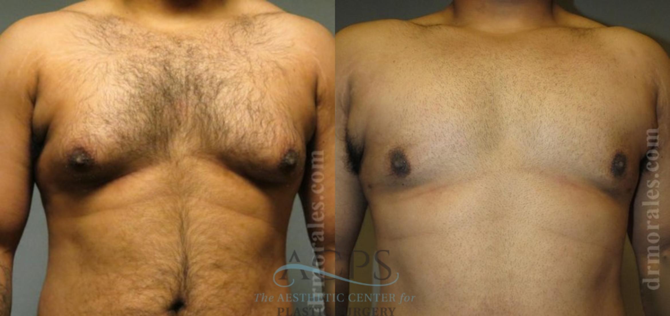 Before & After Gynecomastia Case 1423 Front View: View in Houston, TX