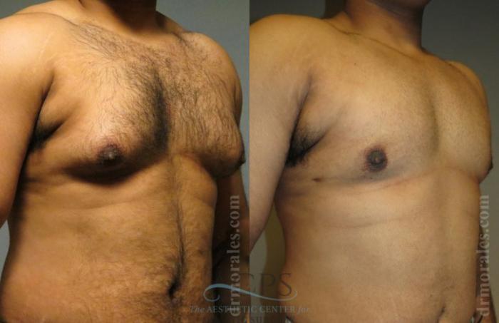 Before & After Gynecomastia Case 1423 Oblique View: View in Houston, TX