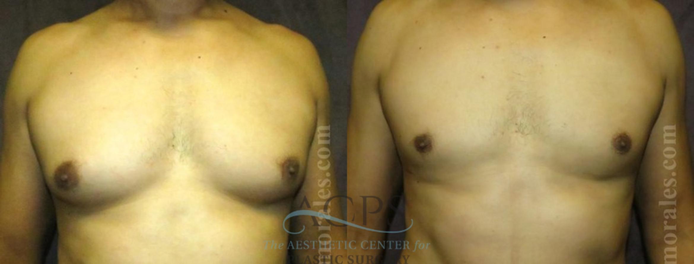 Before & After Gynecomastia Case 1424 Front View: View in Houston, TX