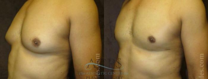 Before & After Gynecomastia Case 1424 Oblique View: View in Houston, TX
