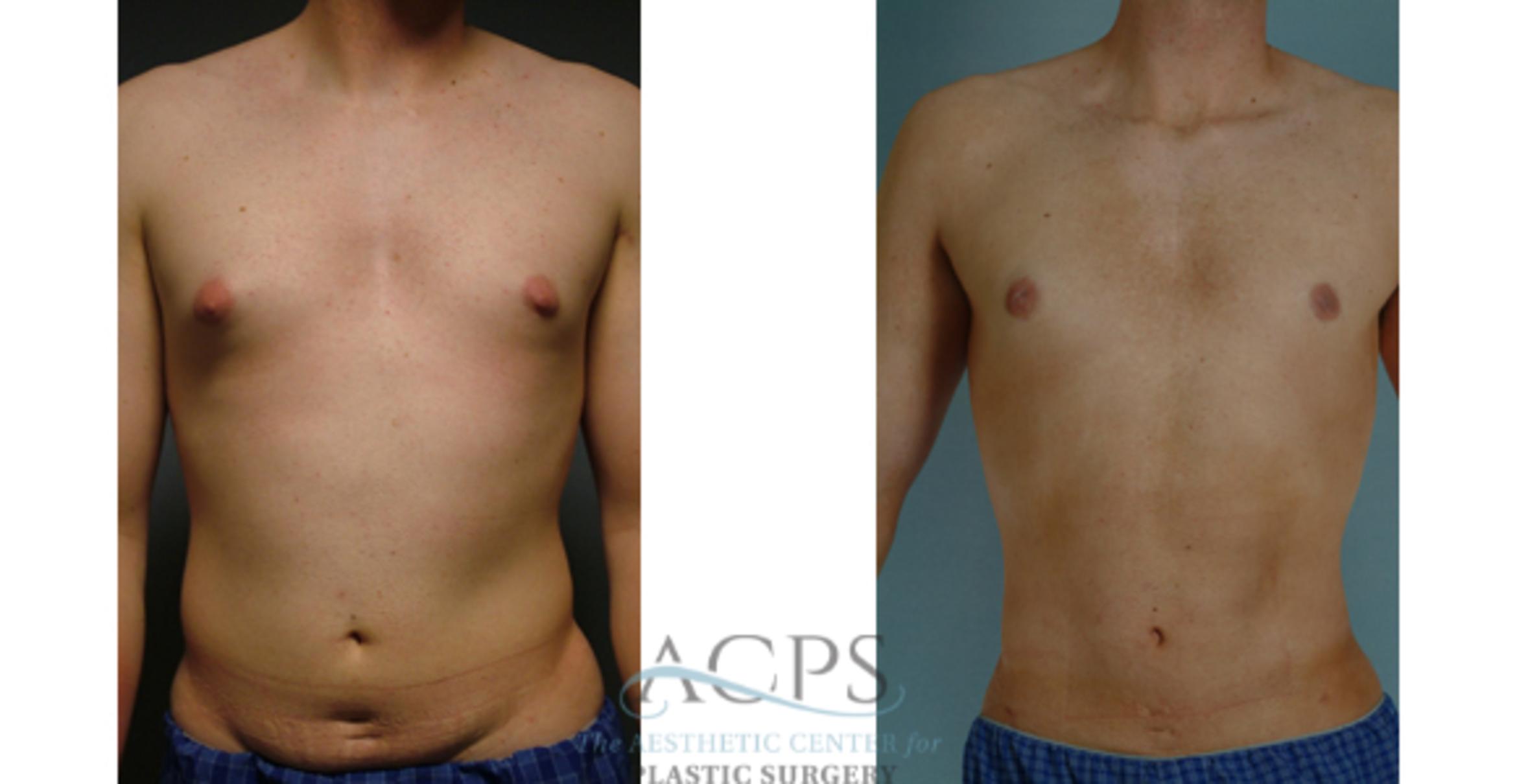 Before & After Gynecomastia Case 1425 Front View: View in Houston, TX