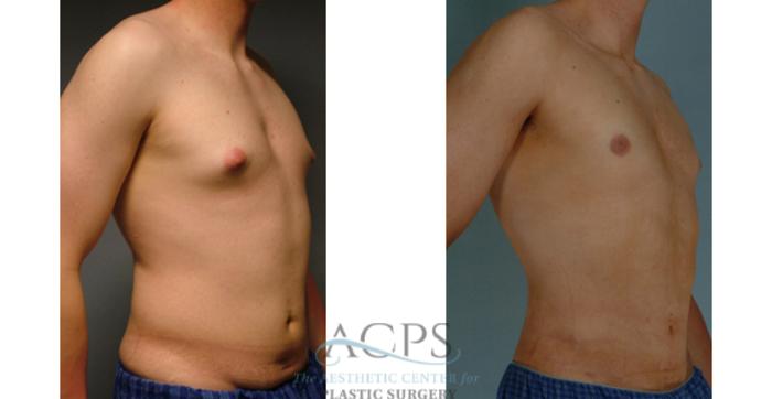 Before & After Gynecomastia Case 1425 Oblique View: View in Houston, TX