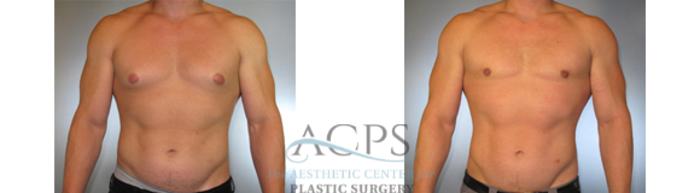 Before & After Gynecomastia Case 1426 Front View: View in Houston, TX