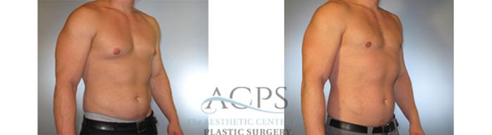 Before & After Gynecomastia Case 1426 Oblique View: View in Houston, TX