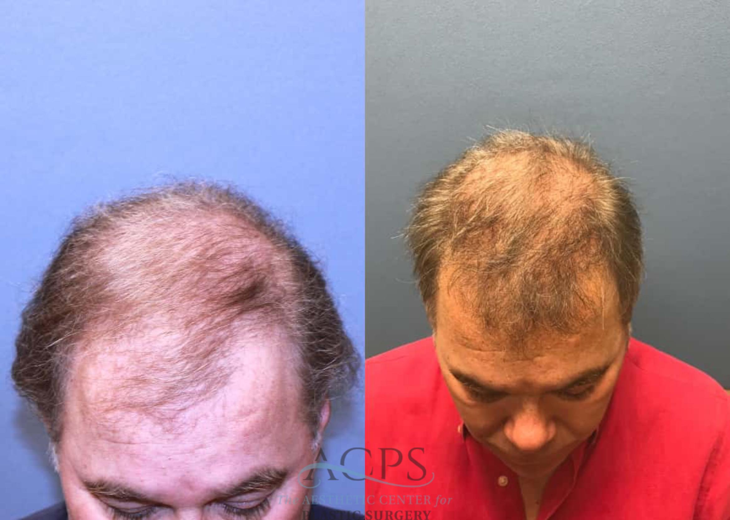 Before & After Hair Restoration Case 1455 Top View in Houston, TX