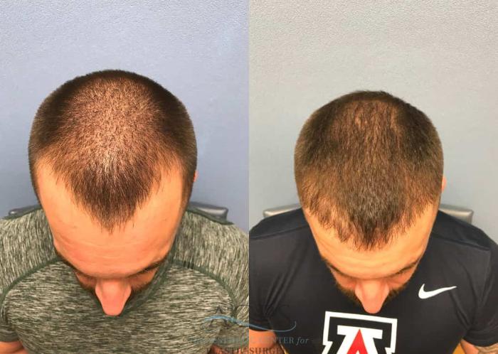 Before & After Hair Restoration Case 1456 Top View in Houston, TX