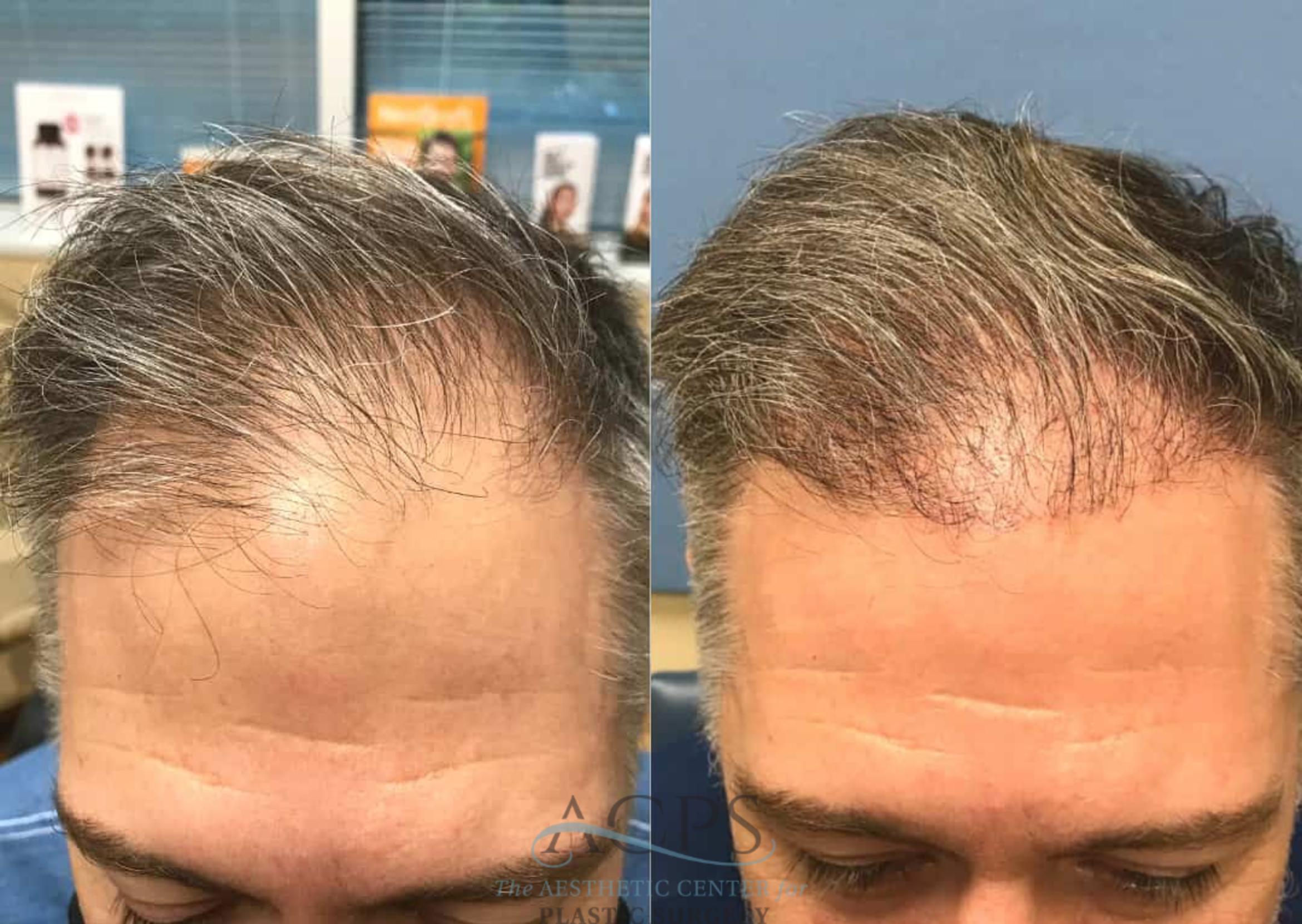 Before & After Hair Restoration Case 1457 Front View in Houston, TX