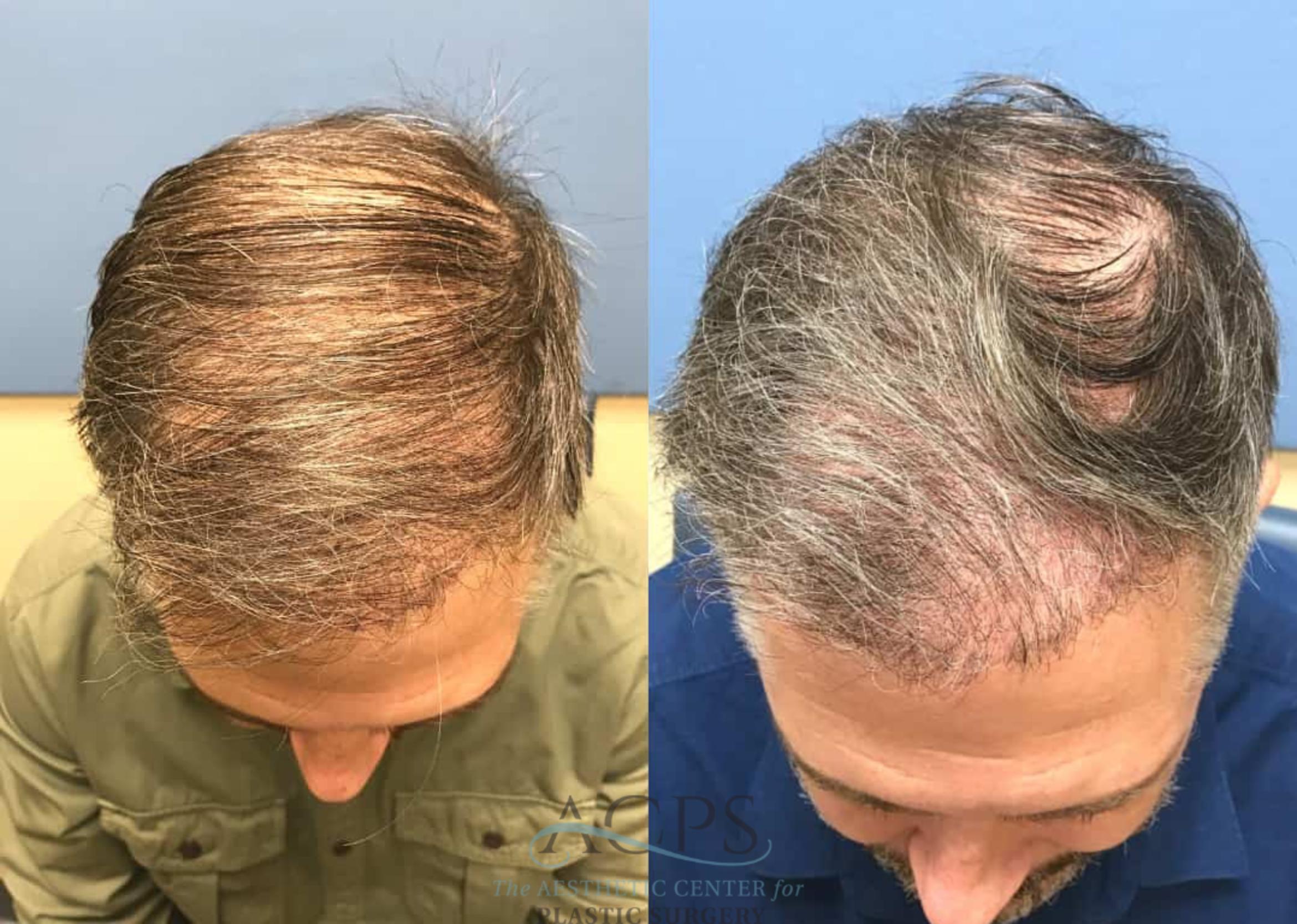 Before & After Hair Restoration Case 1458 Top View in Houston, TX