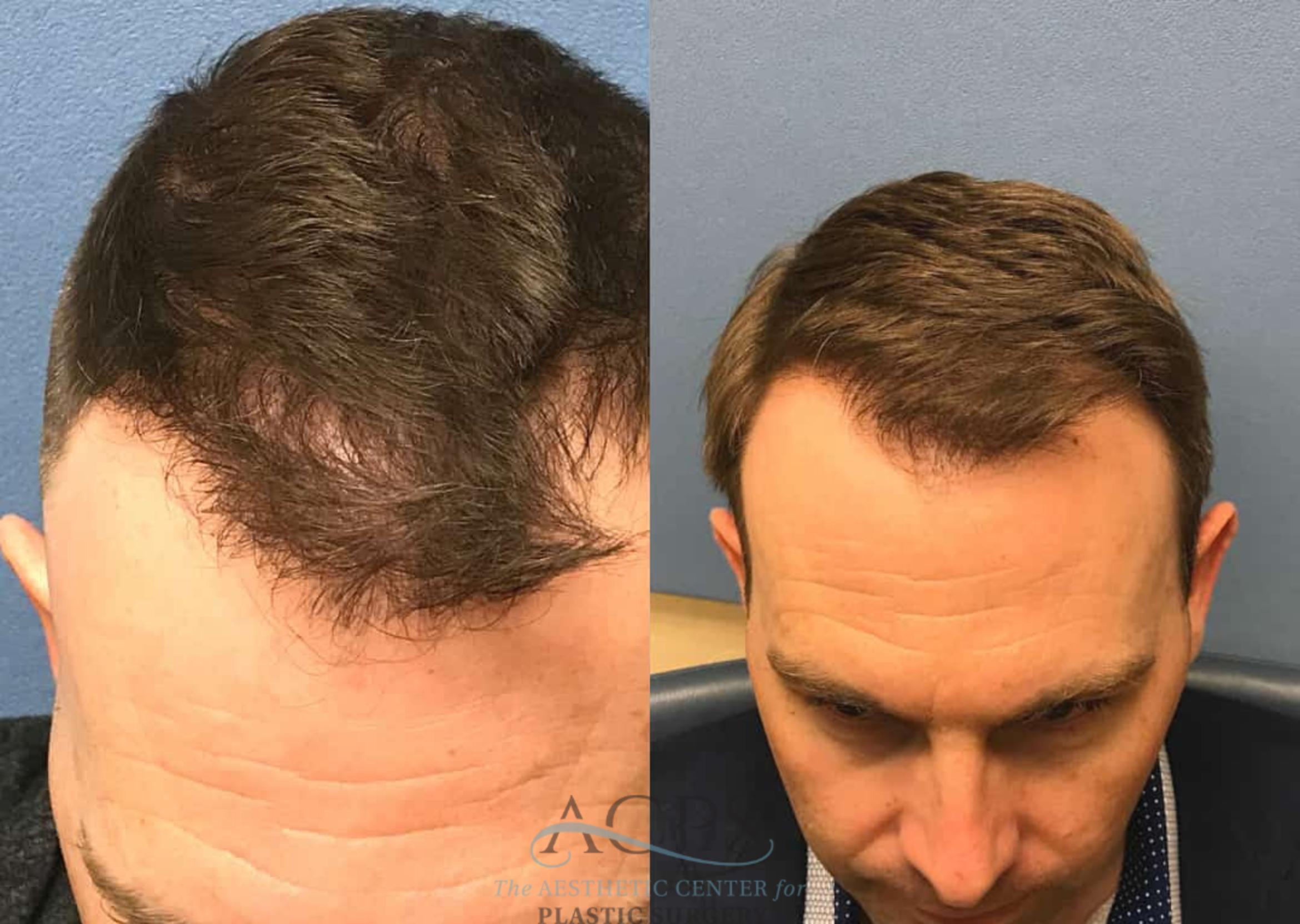 Before & After Hair Restoration Case 1459 Top View in Houston, TX