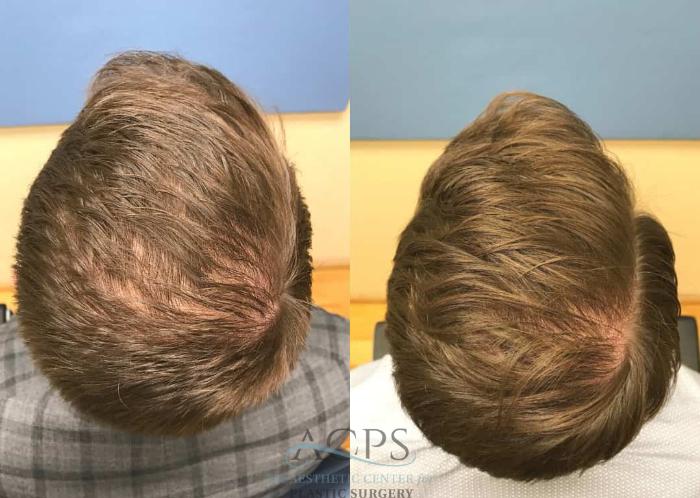 Before & After Hair Restoration Case 1460 Top View in Houston, TX