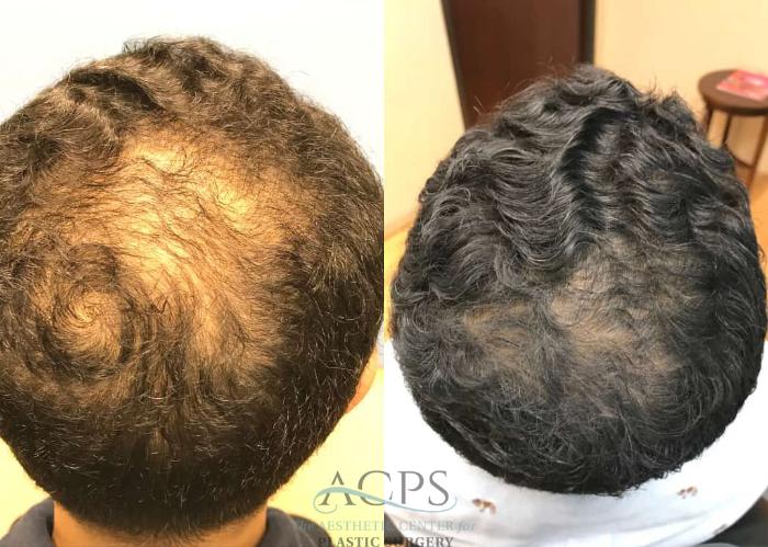 Before & After Hair Restoration Case 1461 Top View in Houston, TX