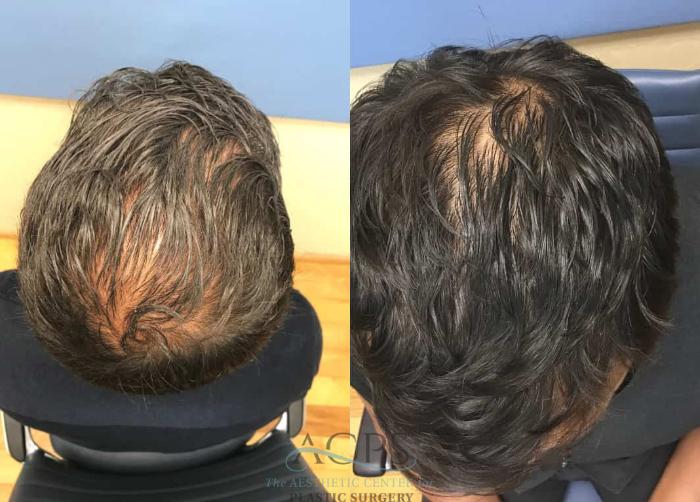Before & After Hair Restoration Case 1462 Top View in Houston, TX