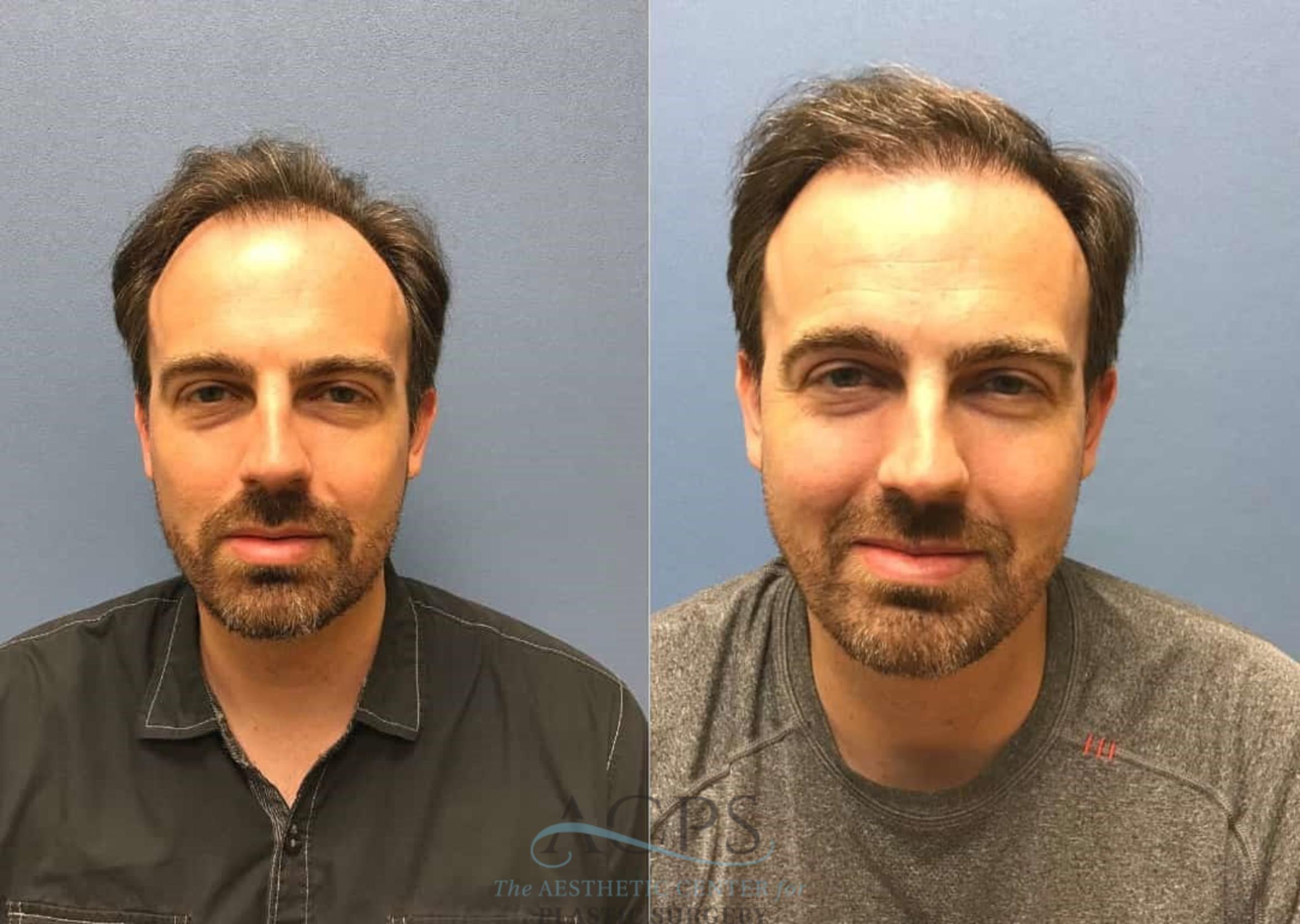 Before & After Hair Restoration Case 1463 Front View in Houston, TX