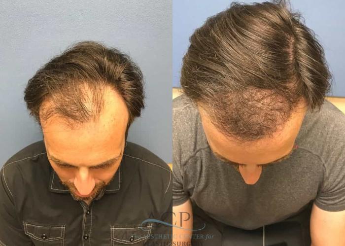Before & After Hair Restoration Case 1463 Top View in Houston, TX