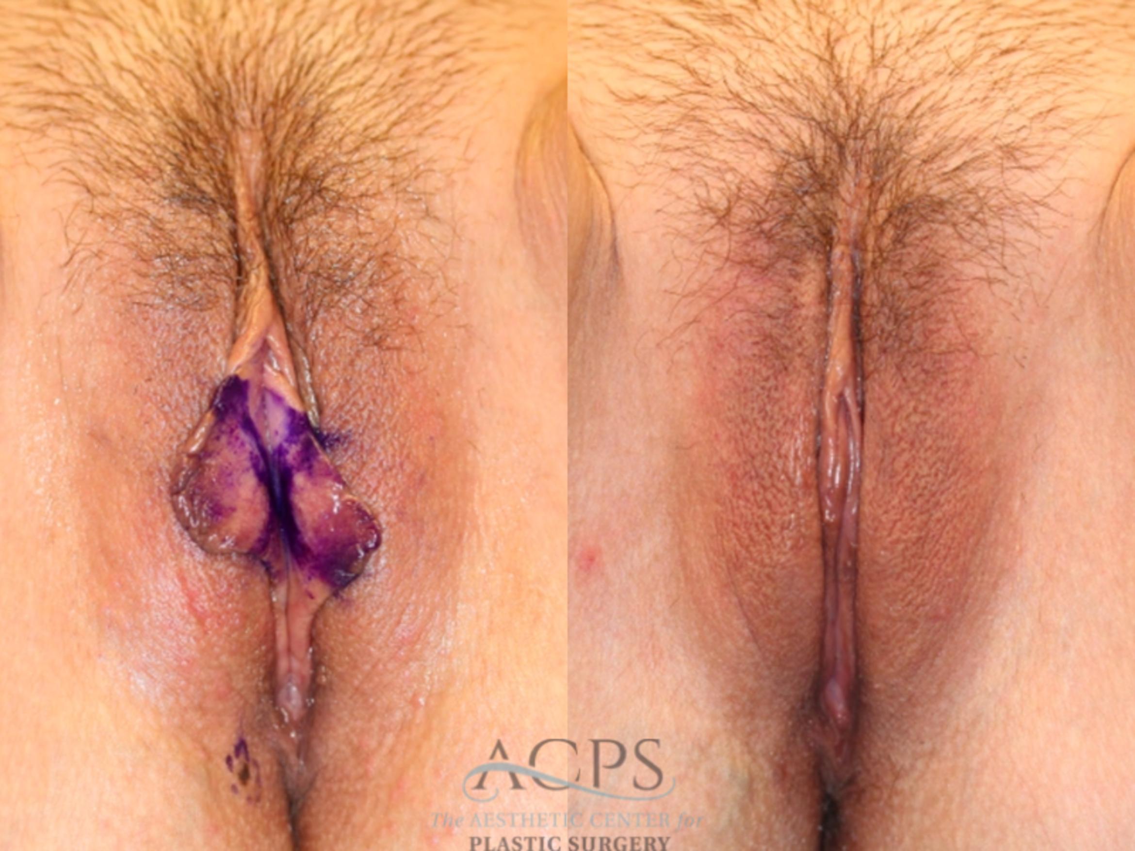 Before & After Labiaplasty Case 1508 Front View in Houston, TX
