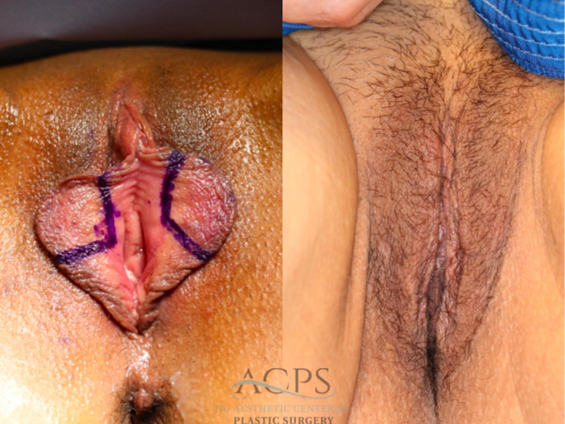 Before & After Labiaplasty Case 1513 Front View in Houston, TX