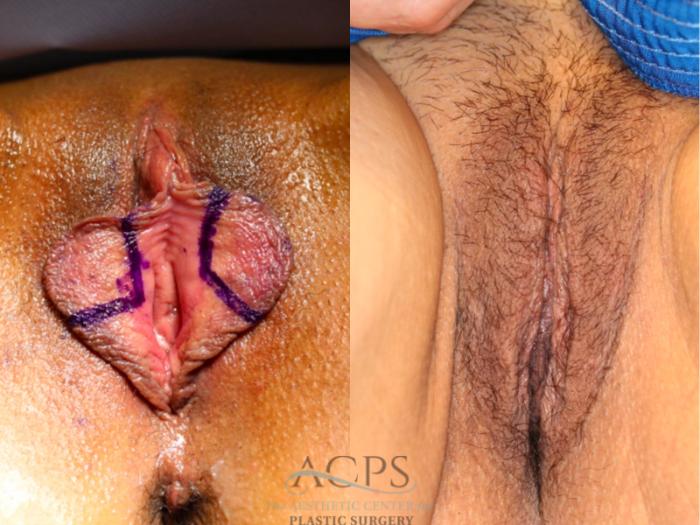 Before & After Labiaplasty Case 1513 Front View in Houston, TX