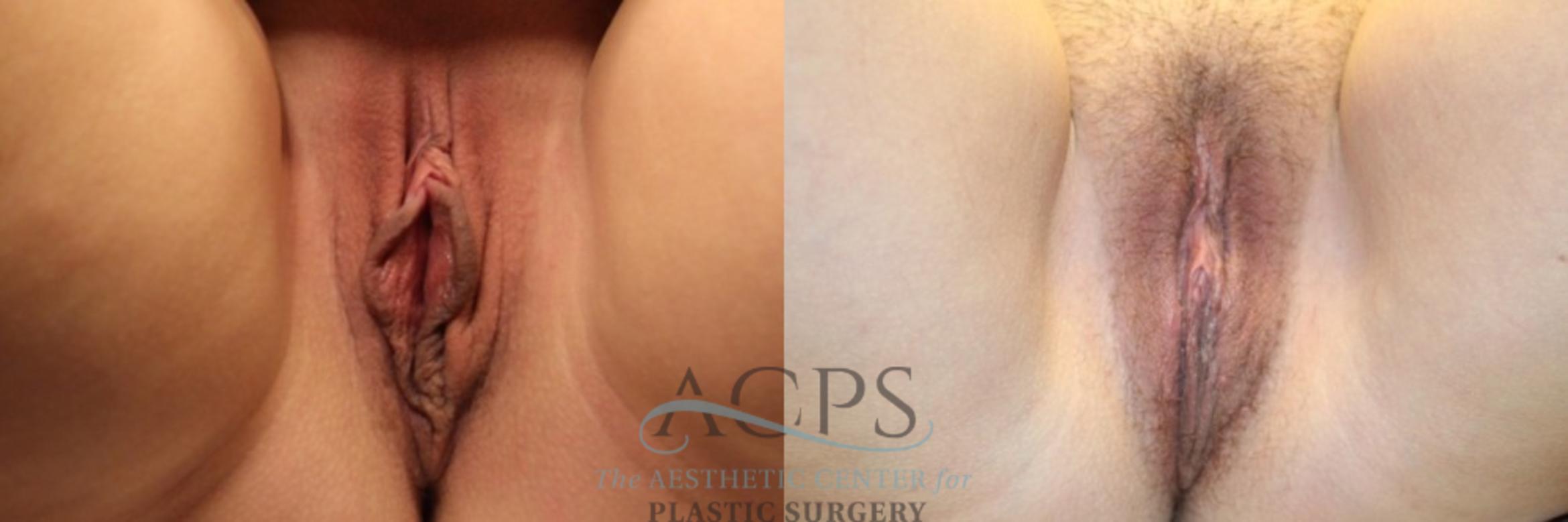 Before & After Labiaplasty Case 801 Front View: View in Houston, TX