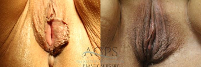 Before & After Labiaplasty Case 802 Front View: View in Houston, TX