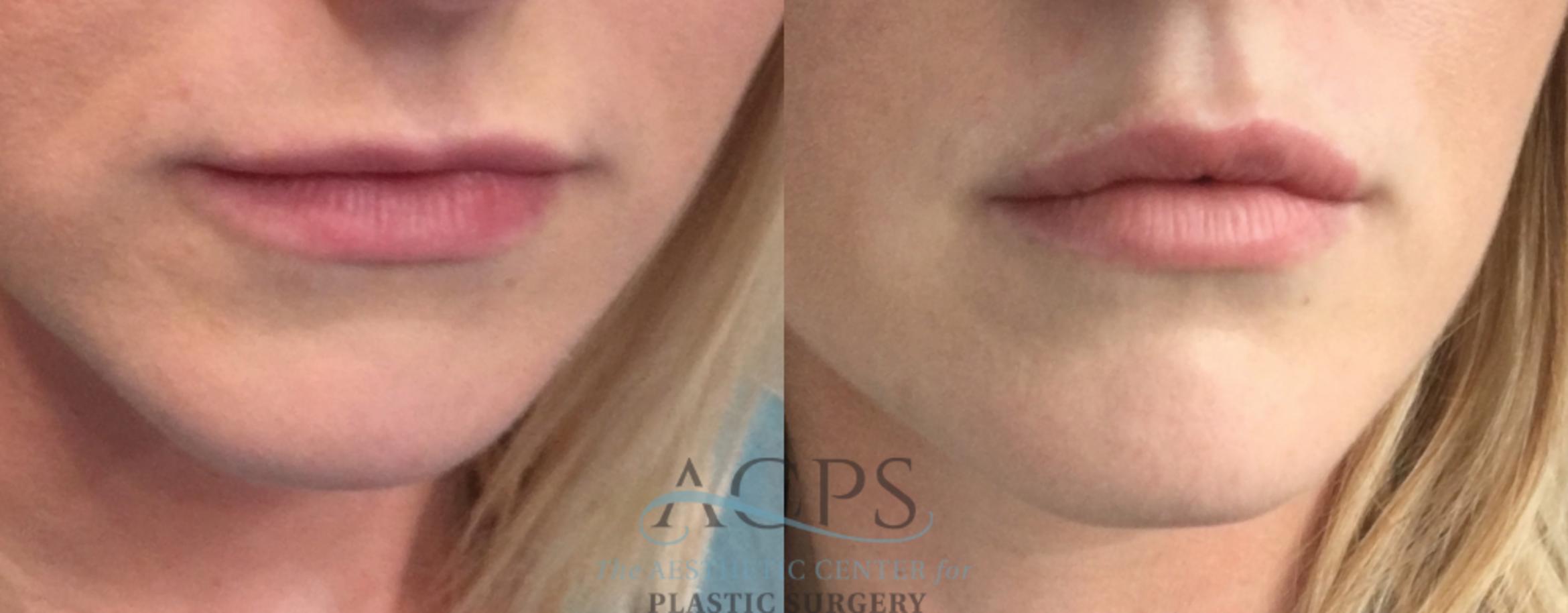 Before & After Lip Injections Case 1427 Front View: View in Houston, TX