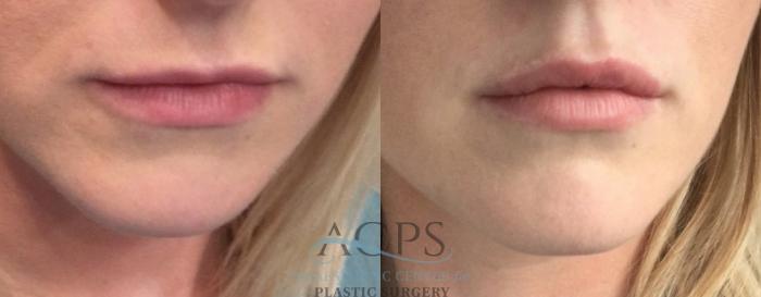 Before & After Lip Injections Case 1427 Front View: View in Houston, TX