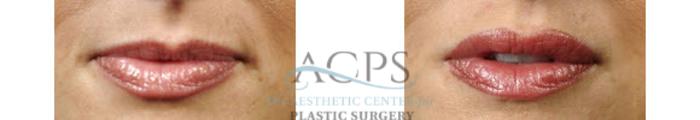Before & After Lip Injections Case 1428 Front View: View in Houston, TX