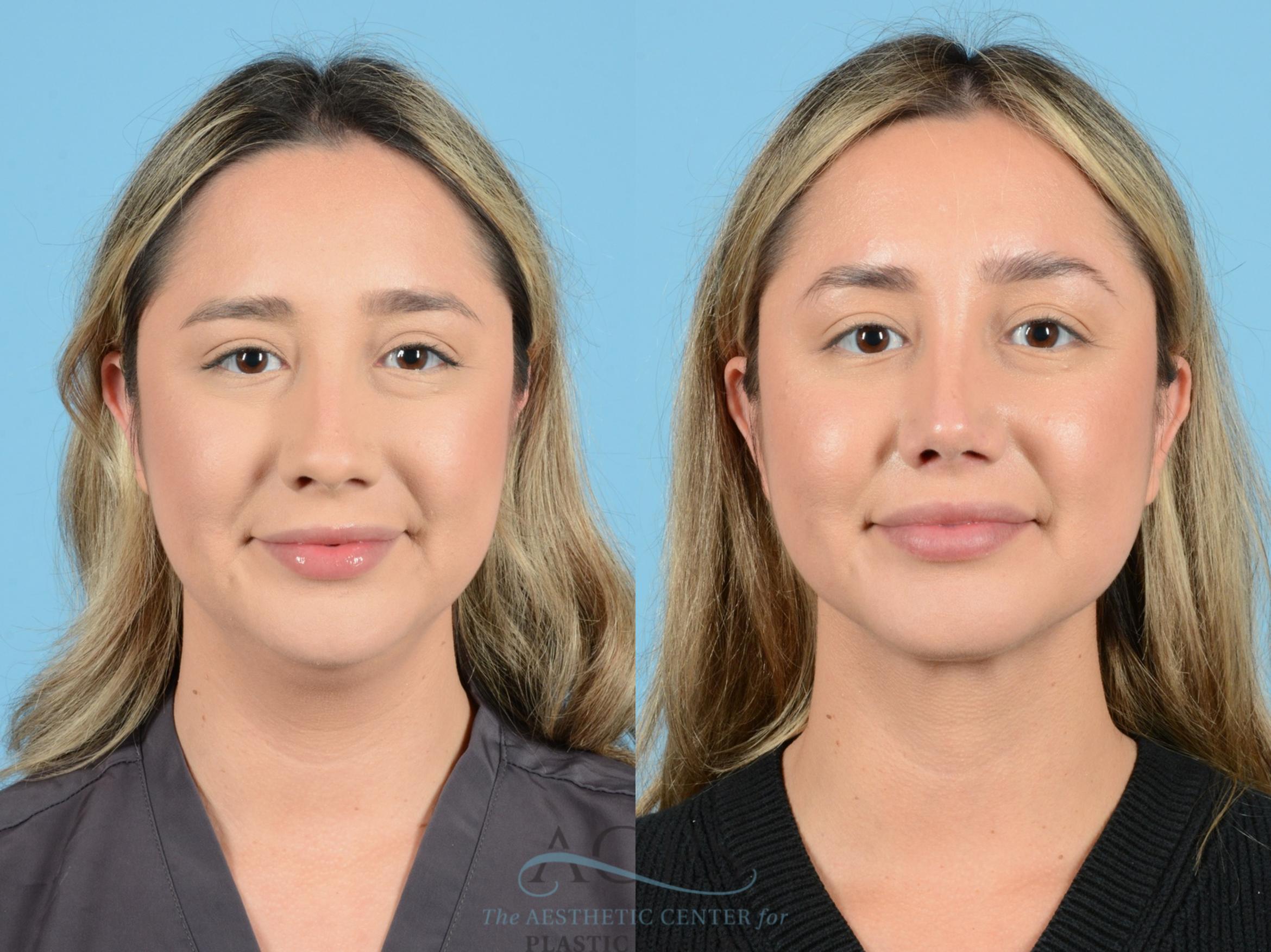 Before & After Liposuction Case 1270 Front View: View in Houston, TX