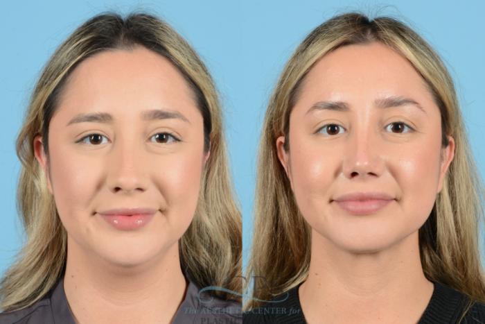 Before & After Liposuction Case 1270 Front View: View in Houston, TX