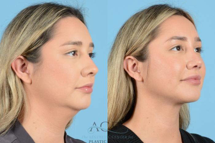 Before & After Liposuction Case 1270 Oblique View: View in Houston, TX