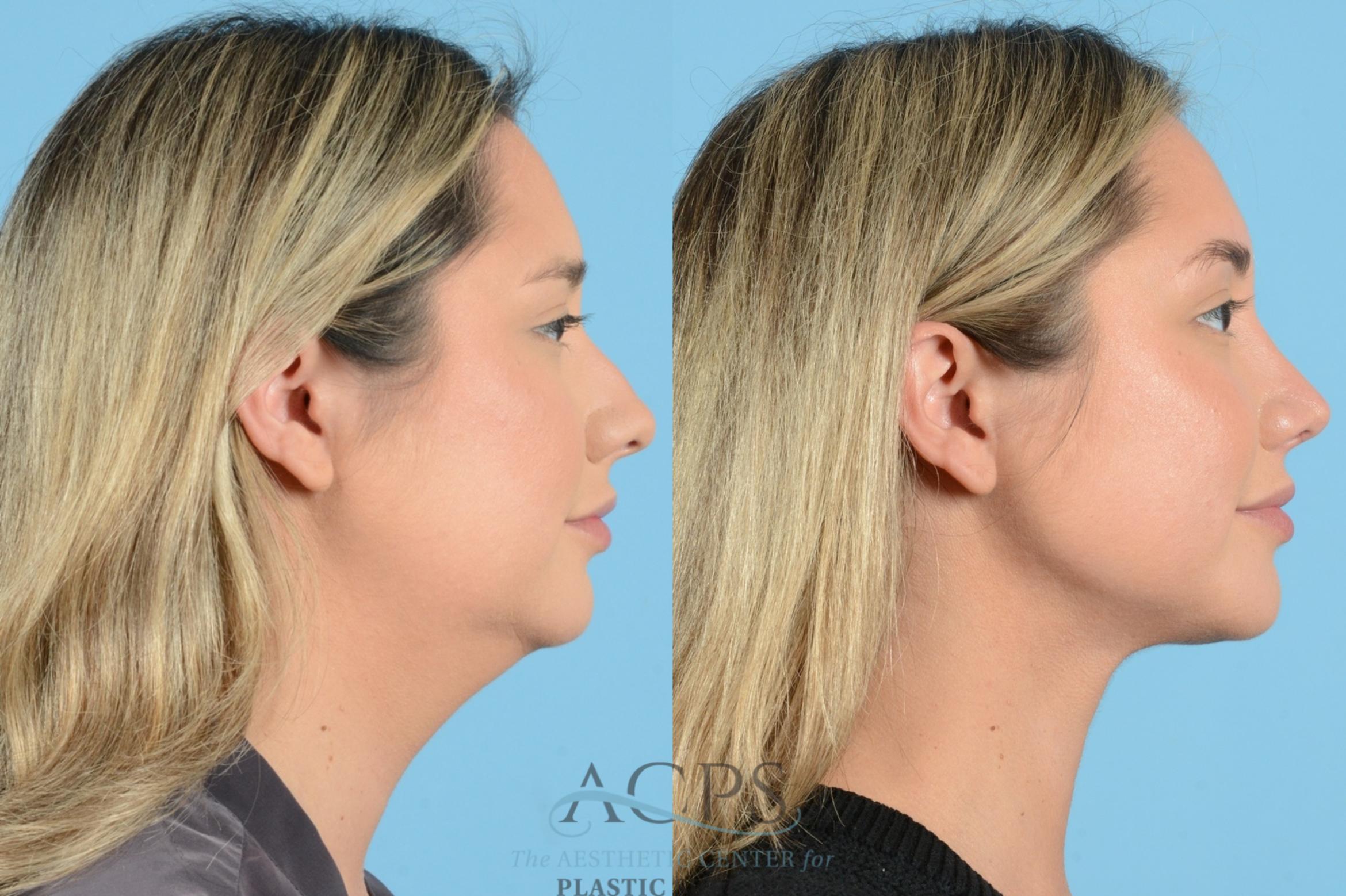 Before & After Liposuction Case 1270 Side View: View in Houston, TX