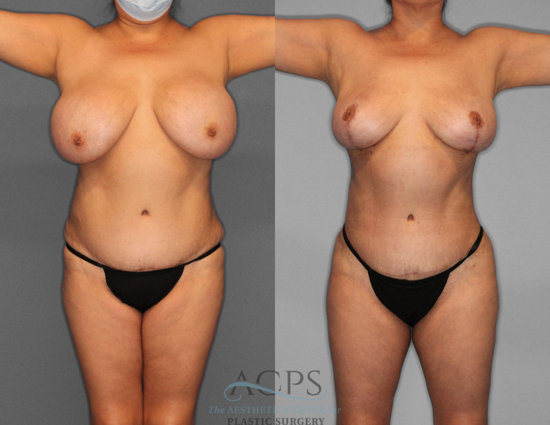 Before & After Liposuction Case 188 Front View: View in Houston, TX