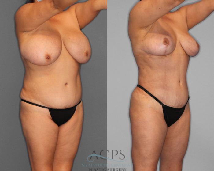Before & After Liposuction Case 188 Oblique View: View in Houston, TX