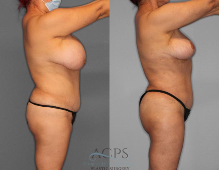 Before & After Liposuction Case 188 Side View: View in Houston, TX